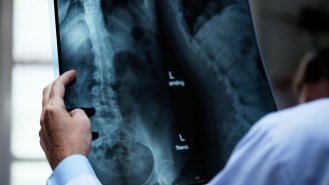 Bechtěrevova nemoc: Tichý zánět, který ovlivňuje životy tisíců Čechů
